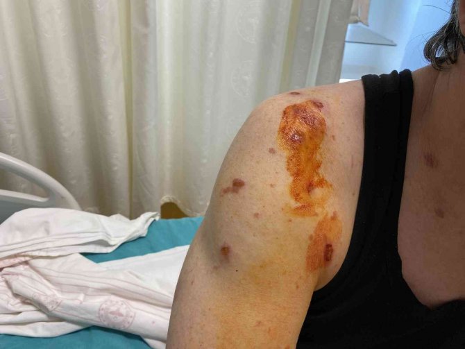 Lavabo Açıcı Bomba Gibi Patladı, Soluğu Hastanede Aldı