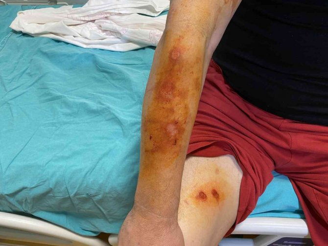 Lavabo Açıcı Bomba Gibi Patladı, Soluğu Hastanede Aldı