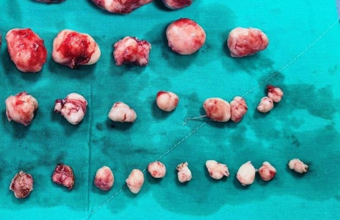 Miyomlar Kısırlığa Neden Olabiliyor