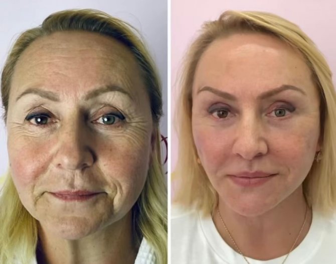 Ameliyatsız Yüz Germeyle Gençleşiyorlar