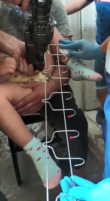 Oyun Oynarken Bacağına Demir Askılığın Kancası Saplandı