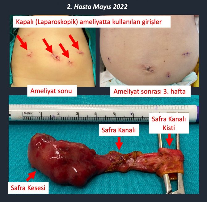 10 Aylık Beren Nisa Bebek Laparoskopiyle Sağlığına Kavuştu