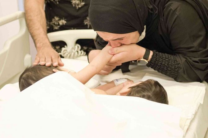 Cezayirli Yapışık İkizler Türkiye’de 9 Saat Süren Operasyonla Ayrıldılar