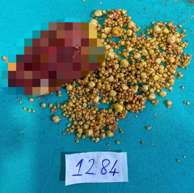 76 Yaşındaki Hastanın Safra Kesesinden Bin 284 Taş Çıktı