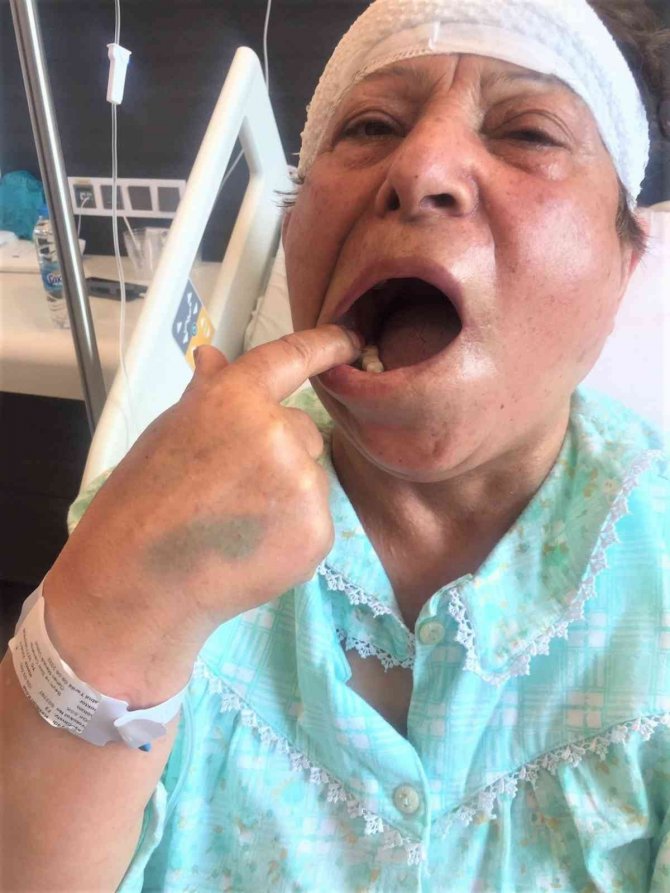 Ağzındaki Bütün Sağlam Azı Dişlerini Çektirdi, Ağrıları Yine De Dinmedi