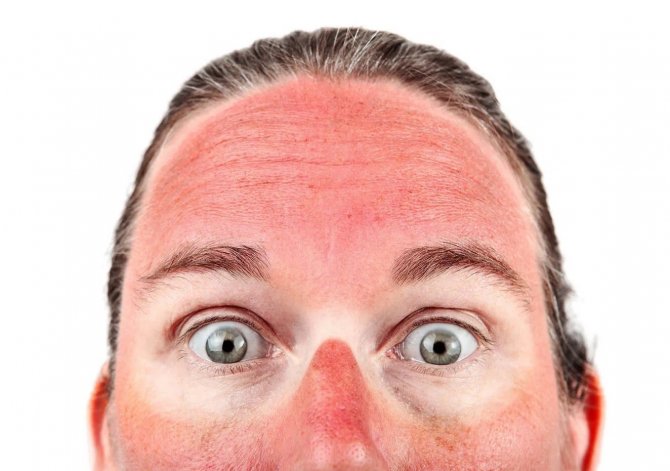 Güneşle Gelen Cilt Lekelerine Dikkat