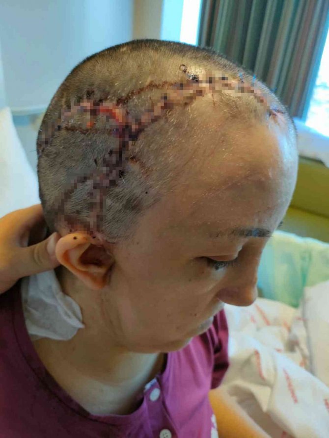 Kafatası Kemiği Kaybolmuştu, Ameliyatla Yenisi Takıldı