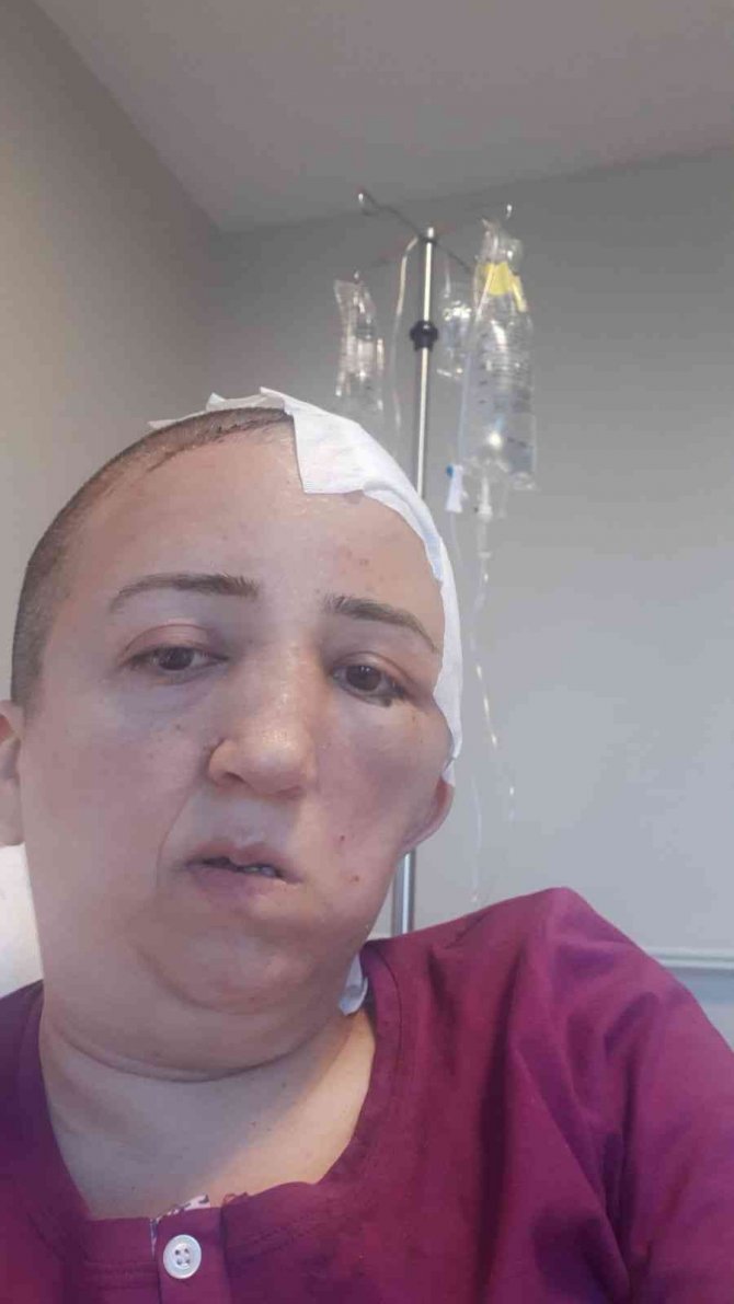 Kafatası Kemiği Kaybolmuştu, Ameliyatla Yenisi Takıldı