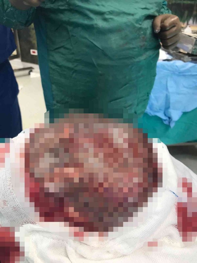 Türk Hekimleri Sayesinde Titanyum Meçlerle Hayata Tutundu