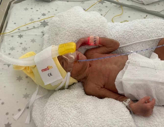 850 Gramlık Birsen Asel Bebek, 100 Günde Yaşama Tutundu