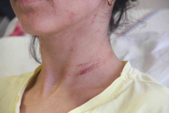 Doktor Sevgilisinin Evinde Dehşeti Yaşayan Genç Kadın 2 Saat Boyunca Darp Edildi, 5 Yerinden Bıçaklandı