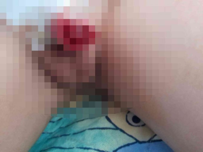 Yanlış Sünnet Edilen Çocuğun Hayatı Karardı: “21 Gündür Su İçmeye Korkuyor”