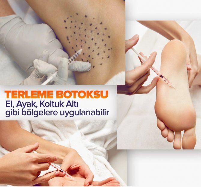 Sosyal Yaşantıyı Ve Öz Güveni Negatif Etkileyen Aşırı Terleme Botoks İle Tedavi Edilebiliyor