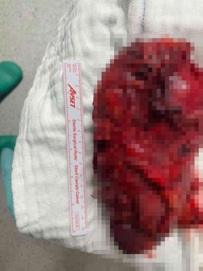 Böbreğinden 2.5 Kilo Tümör Çıkarılan Afganistanlı Türkiye’de Sağlığına Kavuştu