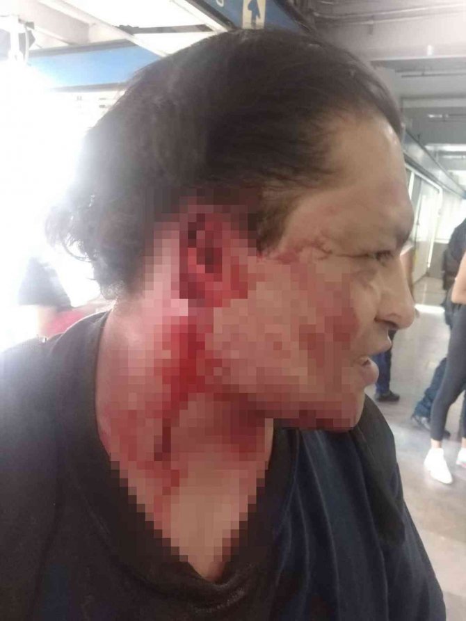 Meksika’da Metroda Kavga Eden İki Kişiden Biri Diğerinin Kulağını Koparttı