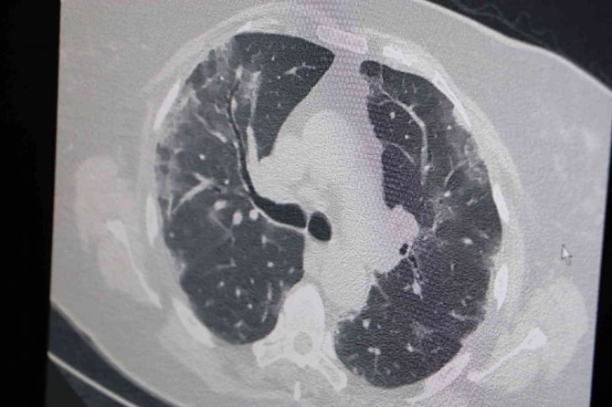 Profesör Artan Korona Ölümlerinin Nedenlerini Açıkladı: "Delta Varyantı Hala Etkisini Gösteriyor"