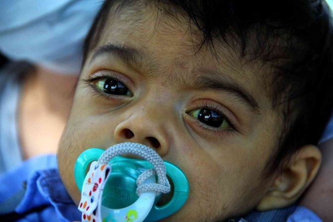 Minik Bulut, 5 Ay Sonra Bulunan Donör İle Hayata Yeniden Tutundu