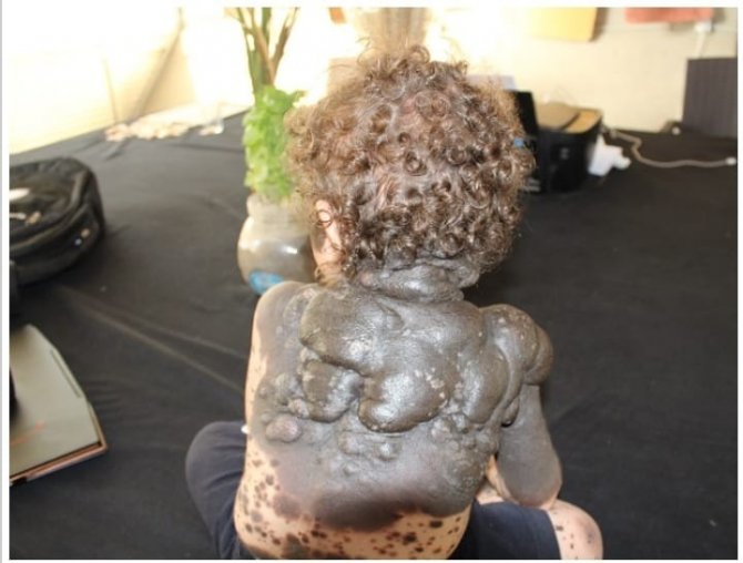 Vücudunda Leke Ve Kitle İle Doğan Bebek Tedavi Ediliyor