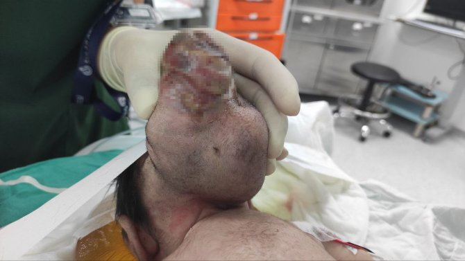 Beyninin Yarısı Kafatası Dışında Dünyaya Geldi