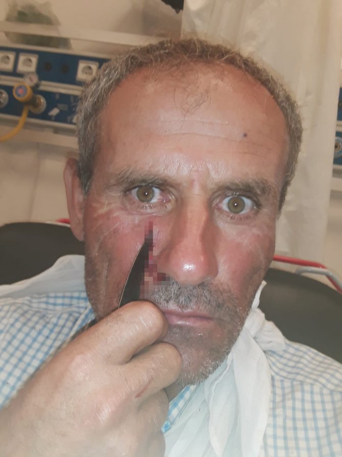 Yüzüne Saplanan Bıçakla Hastaneye Kaldırıldı
