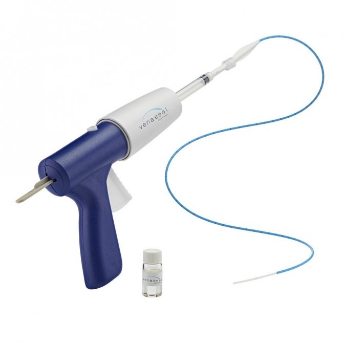 Venaseal Yöntemi İle Varislerinizden Ameliyatsız Kurtulun