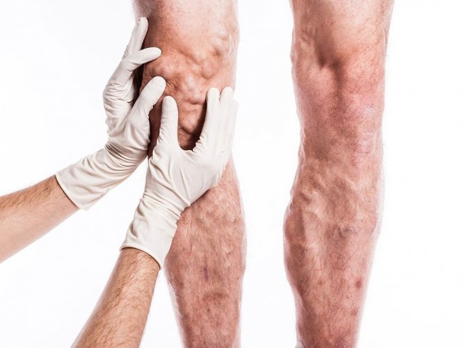 Venaseal Yöntemi İle Varislerinizden Ameliyatsız Kurtulun