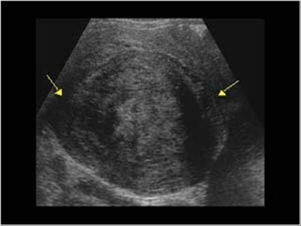 Karındaki Şişlik Kilo Değil Miyom Olabilir