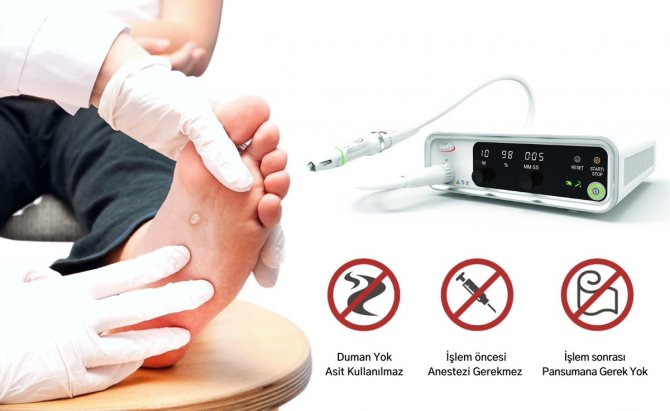 Siğiller Kâbusunuz Olmasın