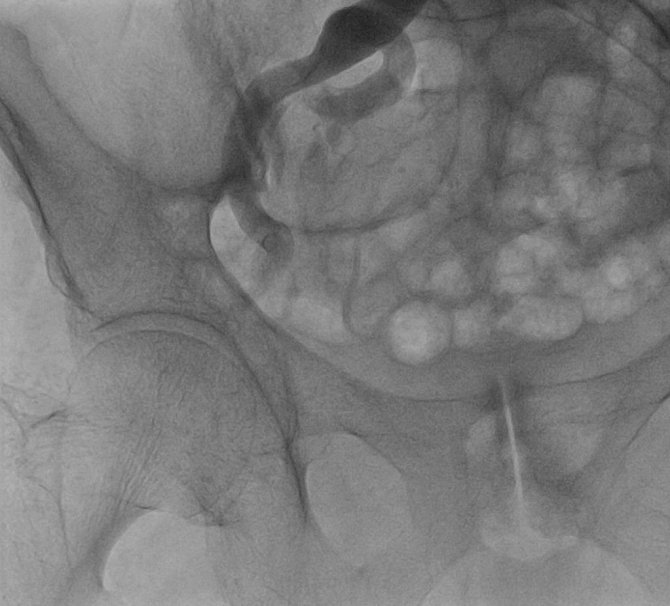 Edirne’de Doktorlar Kalp Hastasına Nefes Oldu