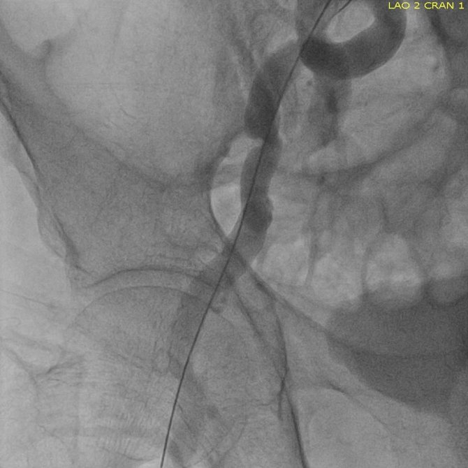 Edirne’de Doktorlar Kalp Hastasına Nefes Oldu