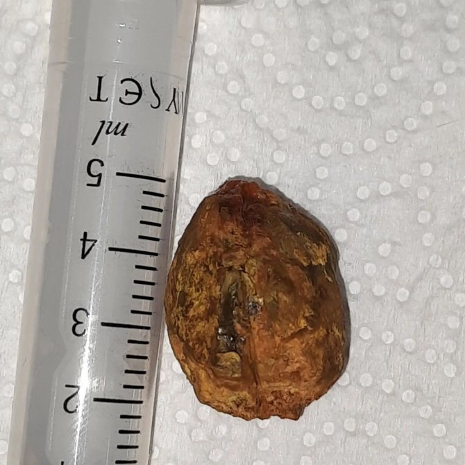 74 Yaşındaki Hasta Safra Yolundaki Taşlardan Ameliyatsız Kurtuldu