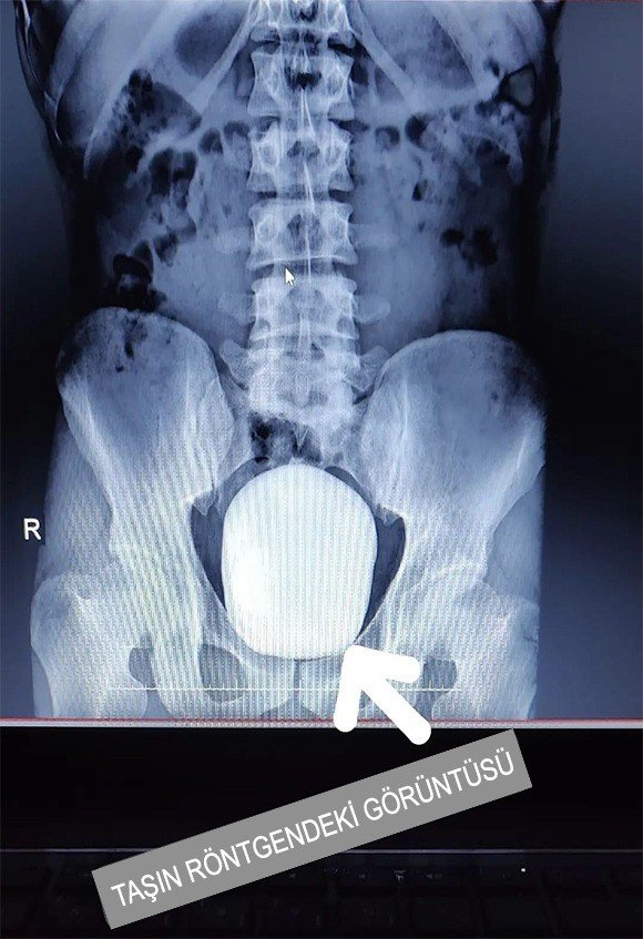 Karaman’da Bir Hastanın Mesanesinden 15x10 Ve 4x3 Büyüklüğünde 2 Taş Çıktı