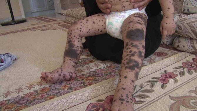 Vücudunda Kitlelerle Doğan Bebeğinin Tedavi Edilmesini İstiyor