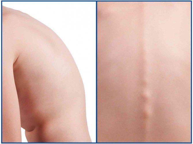 Ebeveynlerin Dikkati, Çocuklarda Görülen Skolyozun Önüne Geçiyor