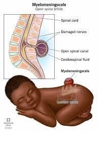 Hamilelik Öncesi Folik Asit Kullanımı Beyin Omurilik Anomalilerini Engelleyebilir