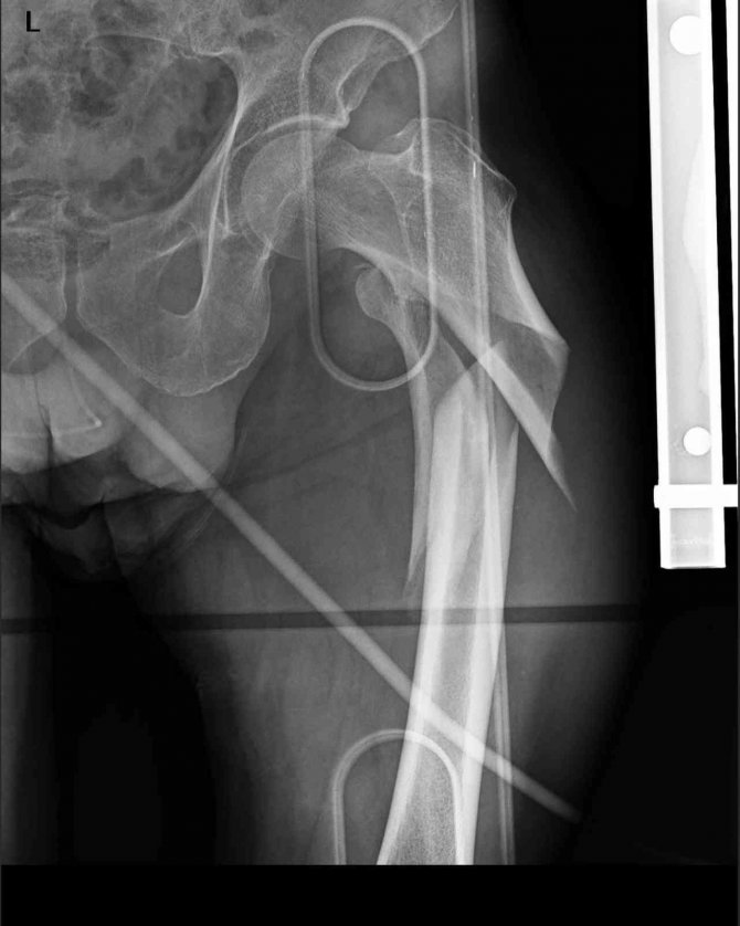 Hastaları Yatağa Bağımlı Kalmaktan Kurtarıyor