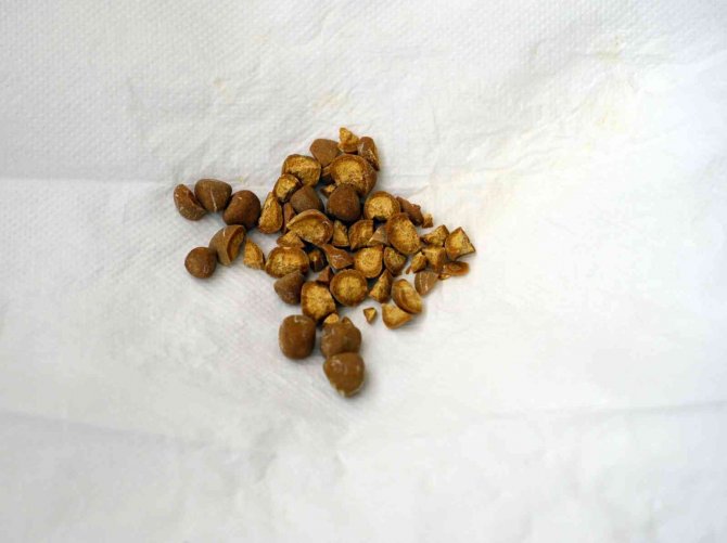 Vücudu Sürekli Taş Üretiyor