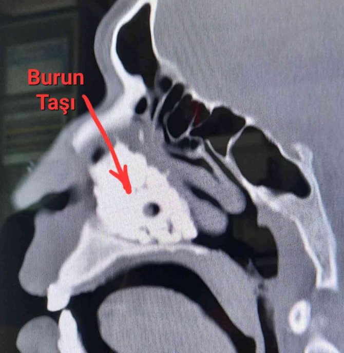 Burnuna Gelen Kötü Koku Gerçeği Ortaya Çıkardı