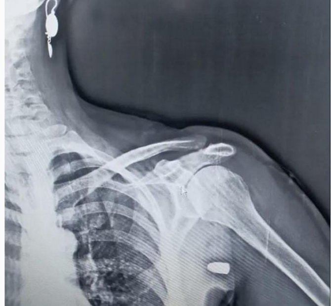 Trabzon’da Tüm Uyarılara Rağmen Yorgun Mermi Vakaları Bitmiyor