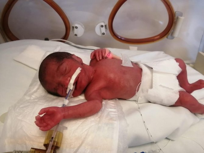 Minik Hüma’nın İnanılmaz Mücadelesi: 720 Gram Doğdu, 102 Gün Yoğun Bakımda Kaldı, Kalp Ameliyatı İle Hayata Tutundu