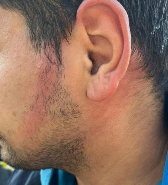 Ümraniye’de İ̇ett Otobüsünün Klima Borusu Patladı, Bir Yolcunun Yüzü Yandı