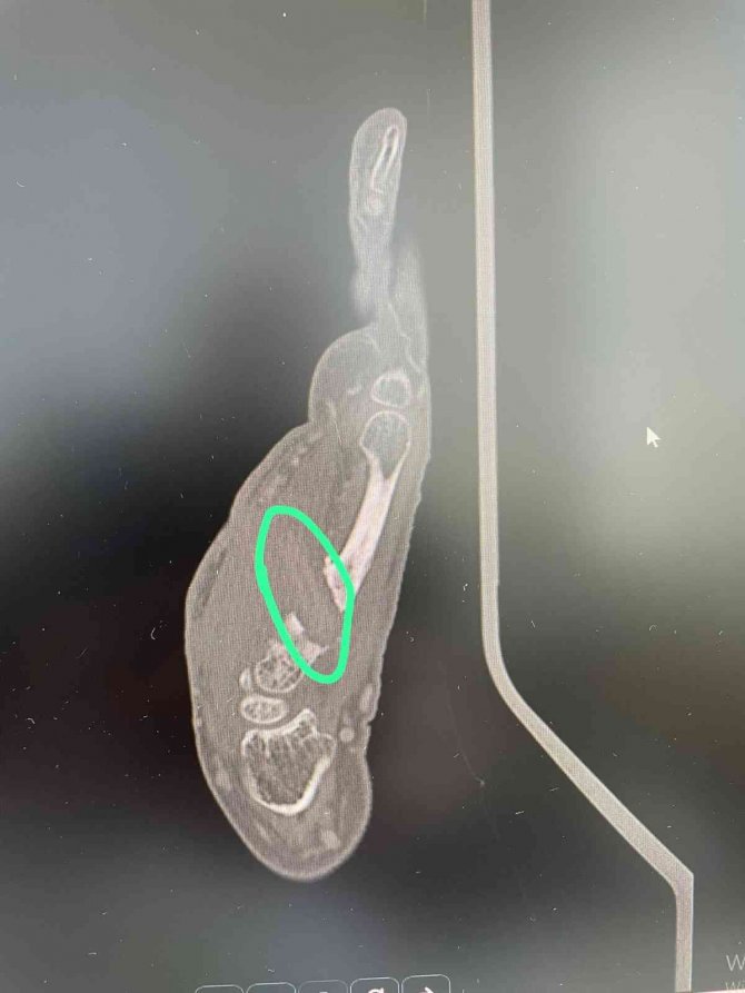 Bu Defa Hastanın Eli İçinde Odun Parçası Unutuldu