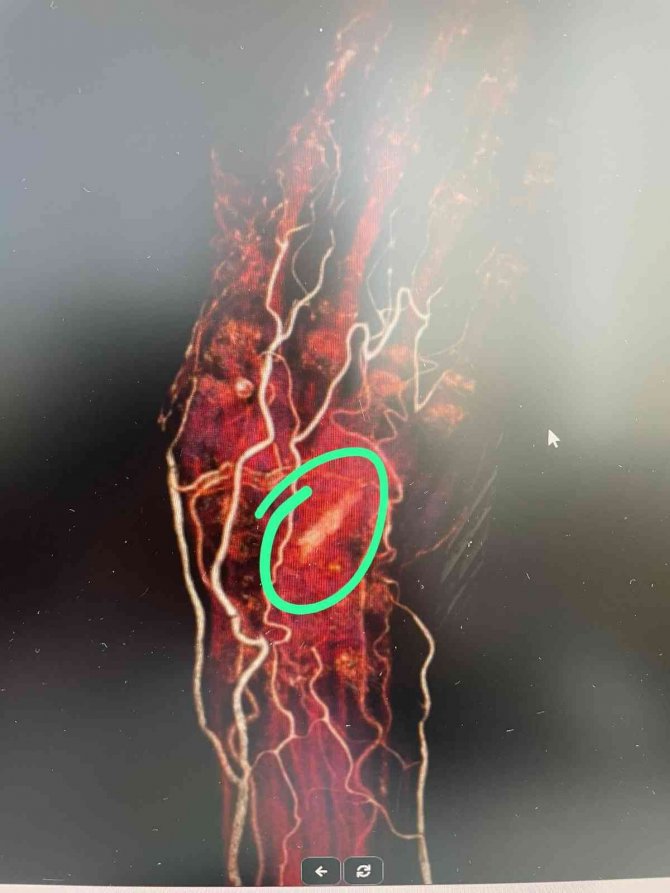 Bu Defa Hastanın Eli İçinde Odun Parçası Unutuldu
