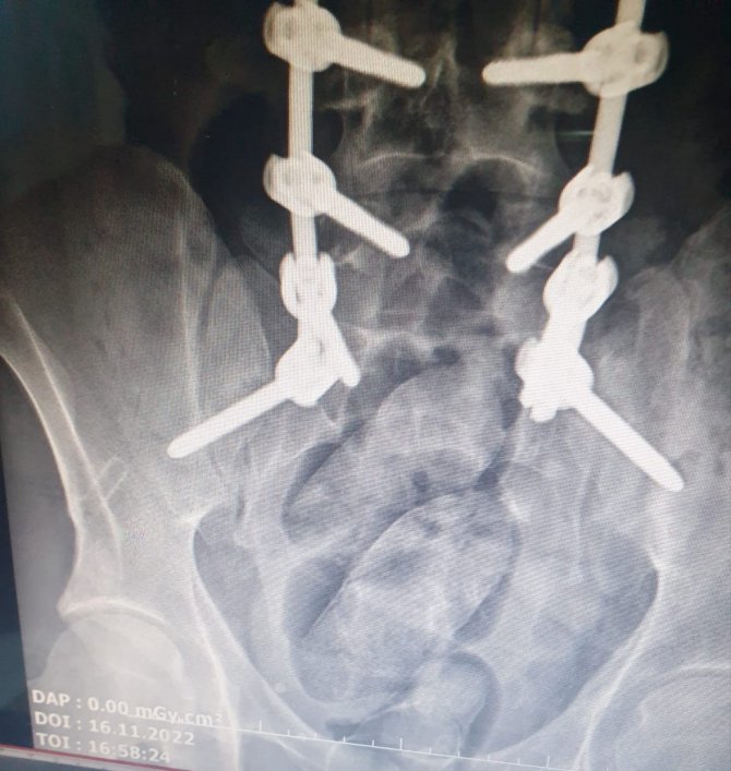 İ̇ranlı Şüphelinin Midesinden 130 Gram Uyuşturucu Çıktı