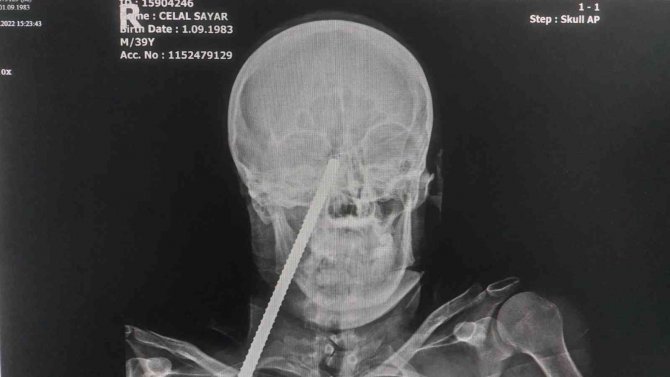 Yüzüne Saplanan Demirle Hastaneye Kaldırıldı