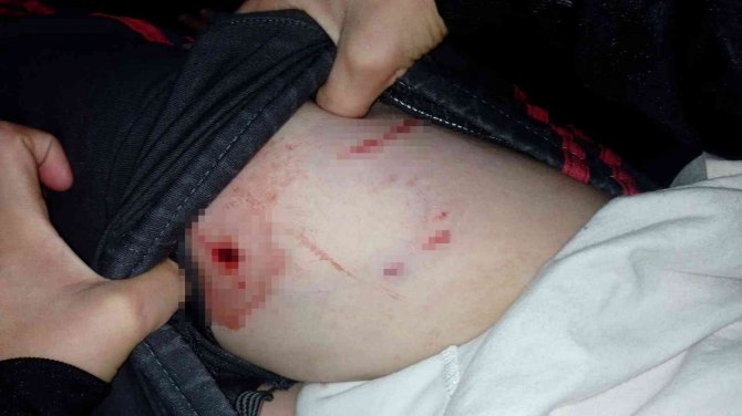 Tekirdağ’da Pitbull Dehşeti: 10 Yaşındaki Çocuğu Bacağından Isırdı