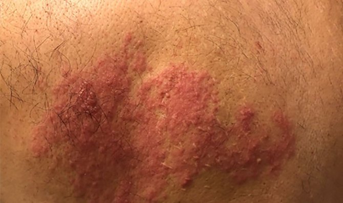 Zayıflayan Bağışıklık Zona Vakalarını Artırdı