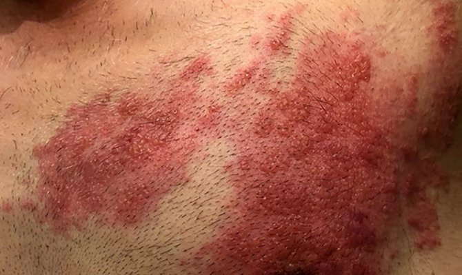 Zayıflayan Bağışıklık Zona Vakalarını Artırdı