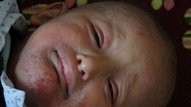 ’Balık Pulu’ Hastalığıyla Yaşayan Çocuğun Hayatı Kabusa Döndü