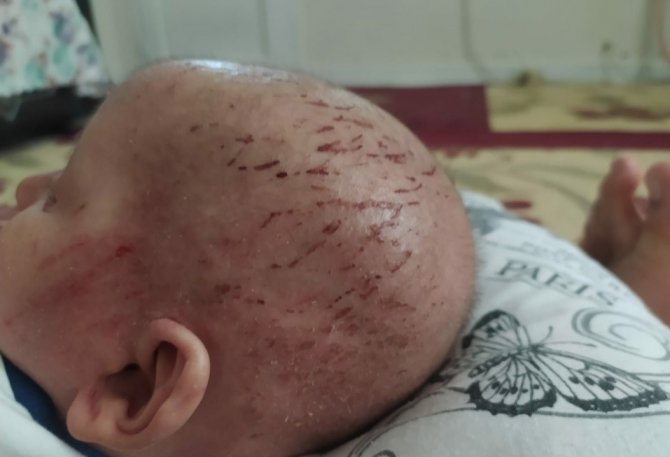’Balık Pulu’ Hastalığıyla Yaşayan Çocuğun Hayatı Kabusa Döndü